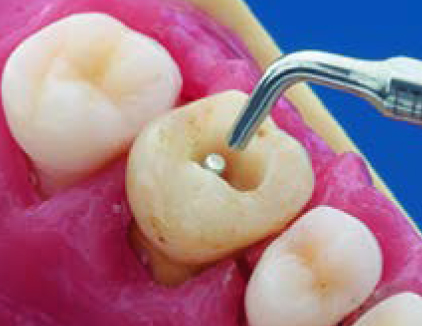 Acteon ETPR – Насадка «эндоперелечивание»