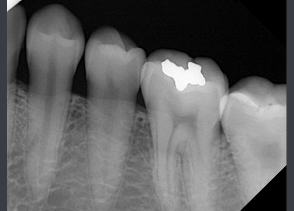 RIOSensor RIS500 - цифровой радиовизиограф 2.jpg