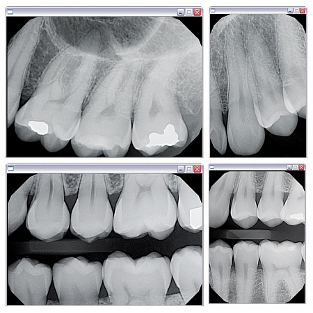 KaVo Gendex GXS-700 - система компьютерной радиовизиографии (сенсор №1)