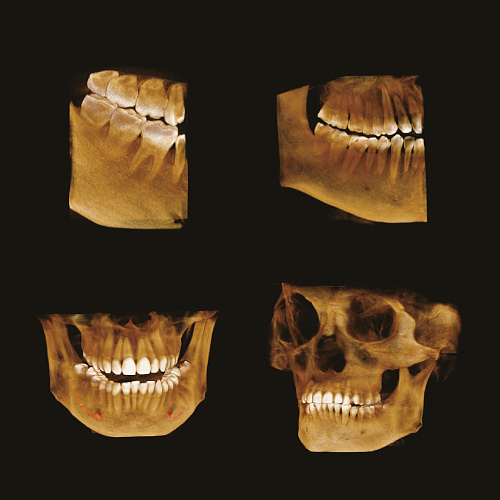 GENORAY Papaya 3D 16x8 - компьютерный томограф